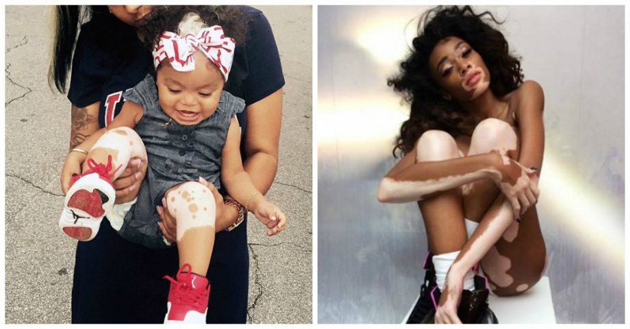 Is the New Winnie Harlow Already Born?